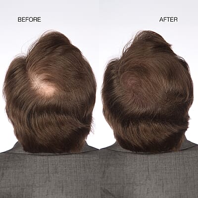 Hairmax Hair Fibers- Brown