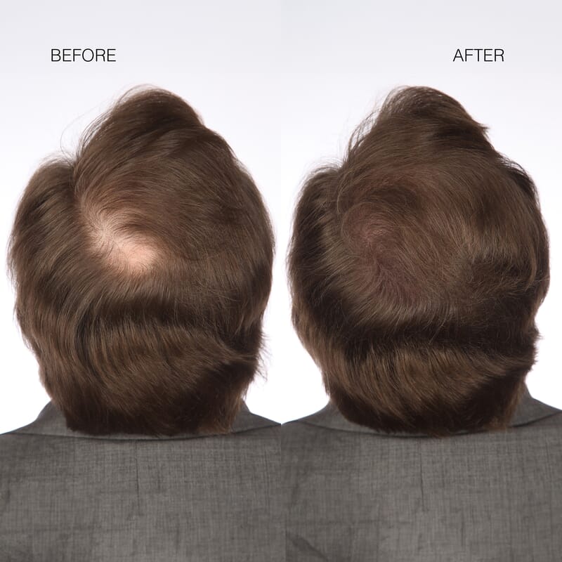 Hairmax Hair Fibers- Brown