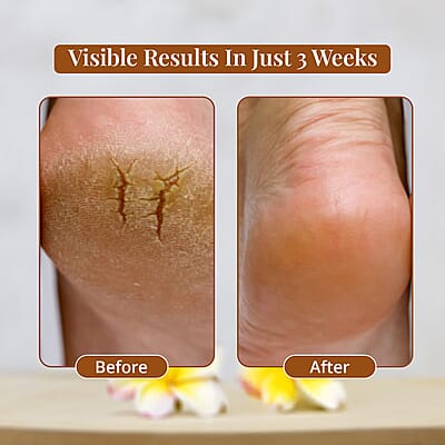 My2Feet Professional Electric Callus Remover (Manufacturer Warranty)