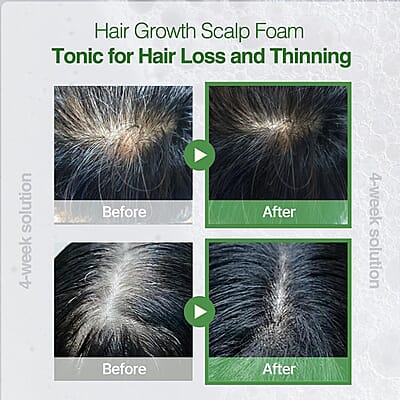 Rootonix Rosemary Scalp Tonic for Scalp Nutrition & Relief (3.38oz) Made in Korea