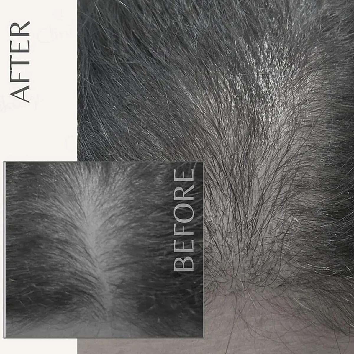 Clinical Results 24/7 Matrixyl Trifecta Collagen Peptide Scalp Treatment Vials with Micro-Needling Applicator (4x .34oz) Made in US (Del. in 5-7 Days) image number 6